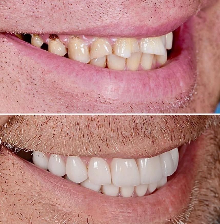 before-and-after-implants-and-veneers