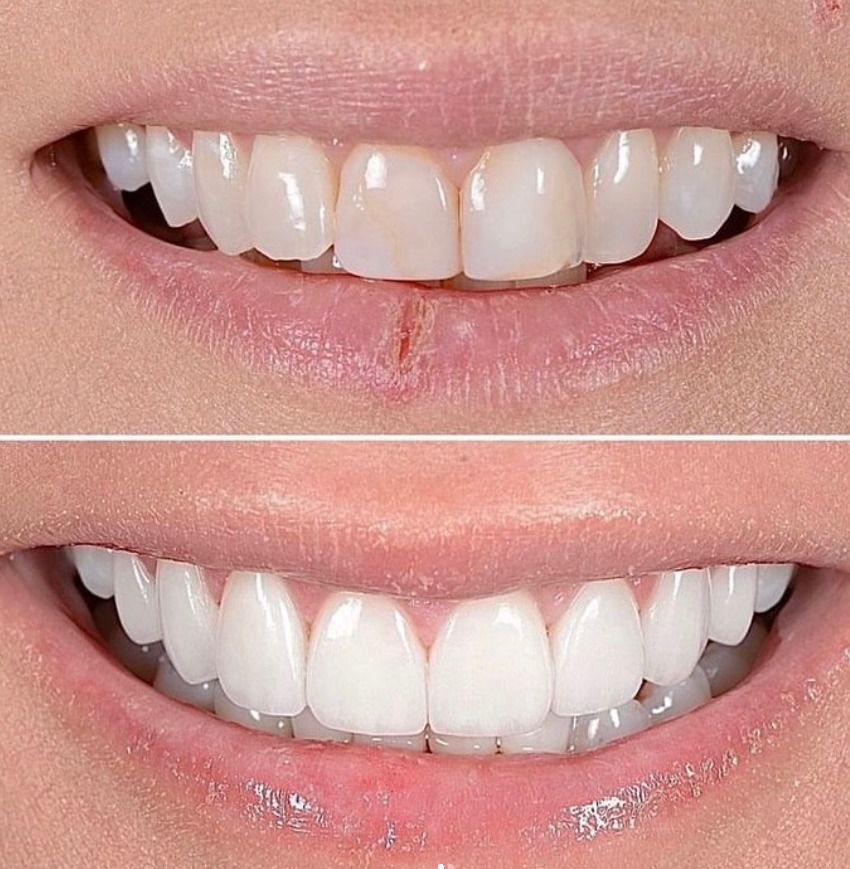 hollywood smile makeover in turkey