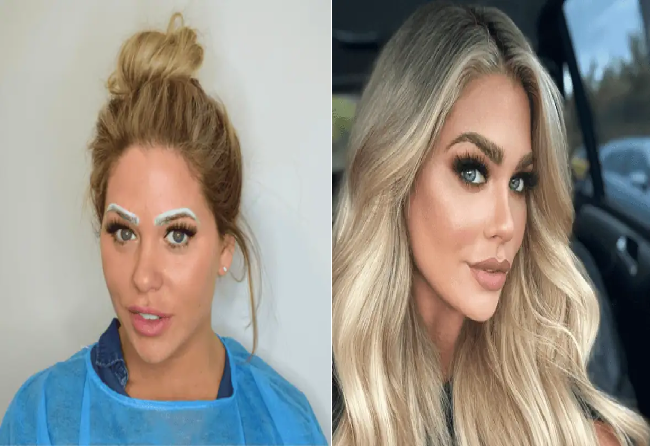 Female hair transplant Istanbul