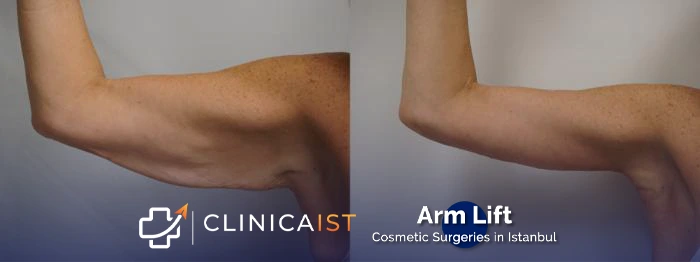 arm-lift-before-after-1