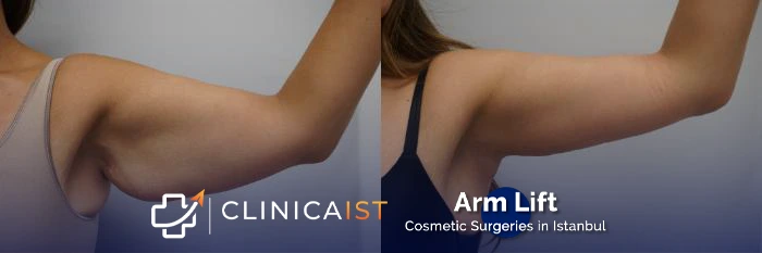 arm-lift-before-after-2