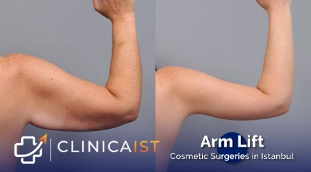 arm-lift-before-after