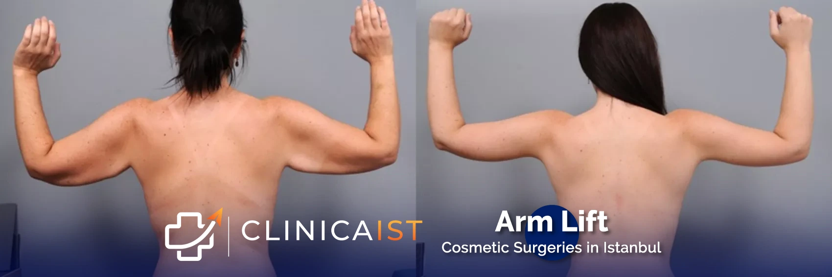arm-lift-before-and-after