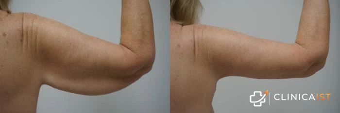 arm-lift-istanbul-before-and-after
