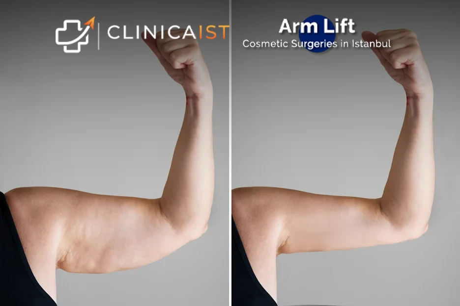 arm-lift-turkey-before-and-after-1