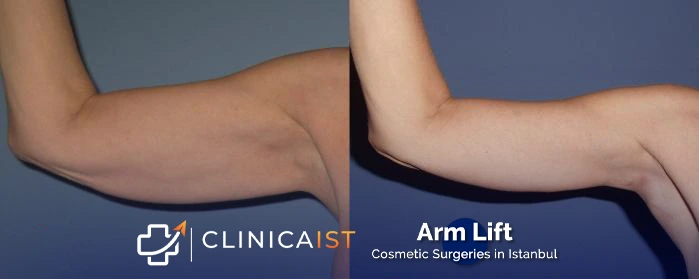 arm-lift-turkey-before-and-after