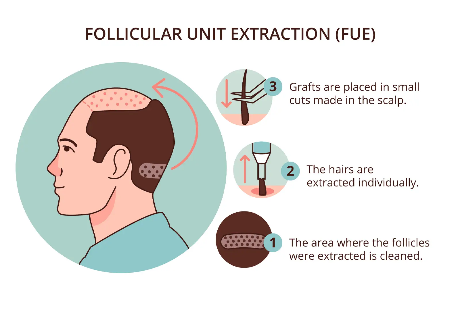 FUE Hair Transplant Turkey