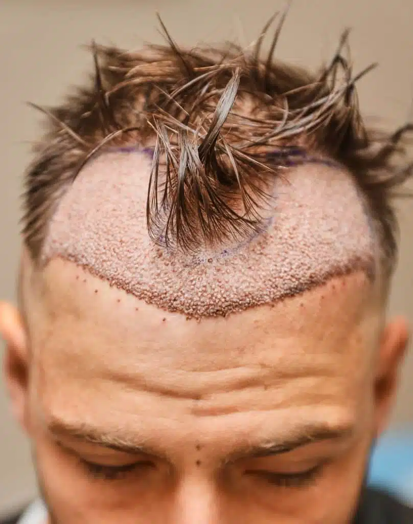 Unshaven FUE hair transplant Turkey