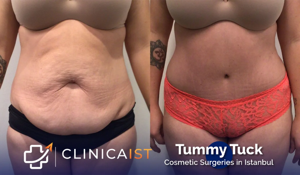 tummy-tuck-before-after-1