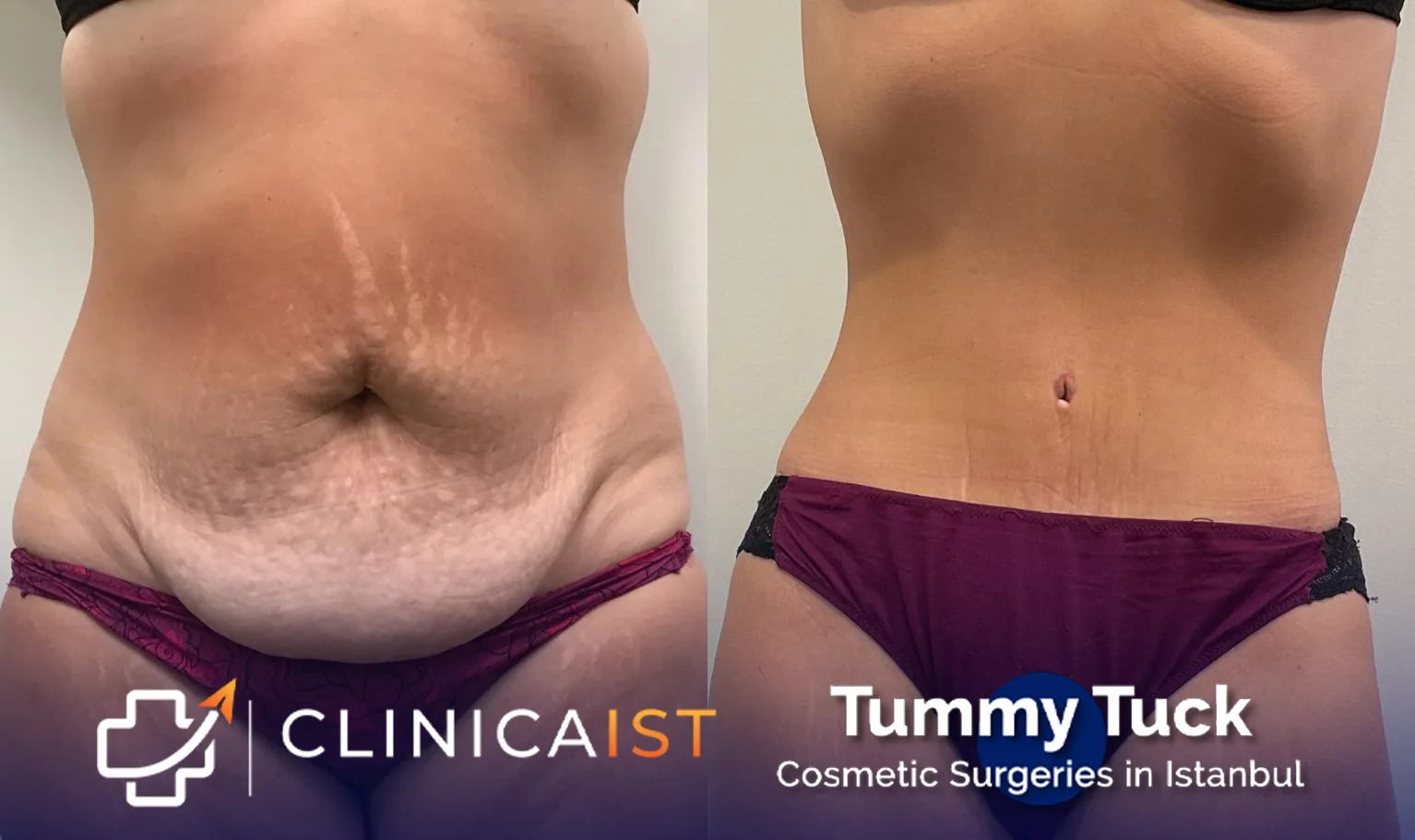 tummy-tuck-before-after-2