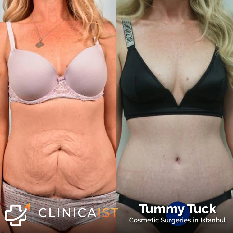 tummy-tuck-before-after-3