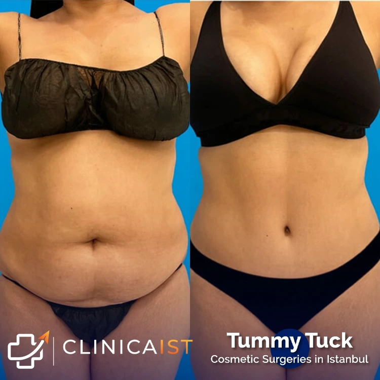 tummy-tuck-before-after