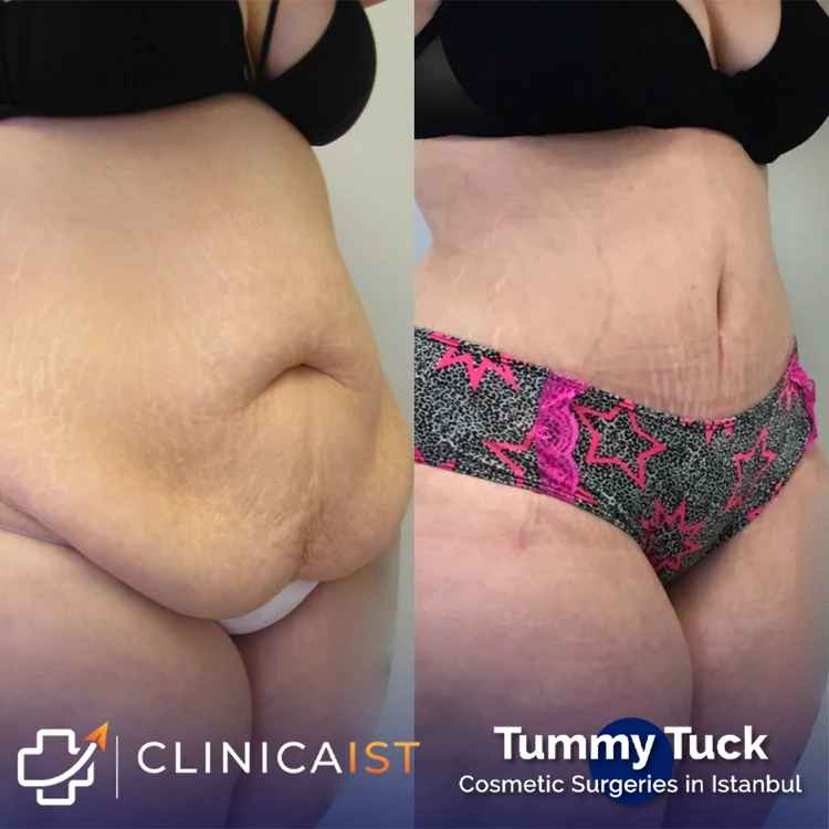 tummy-tuck-before-and-after