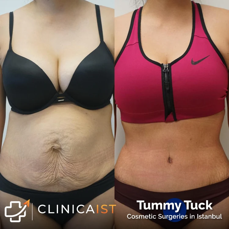 tummy-tuck-istanbul-before-after-1