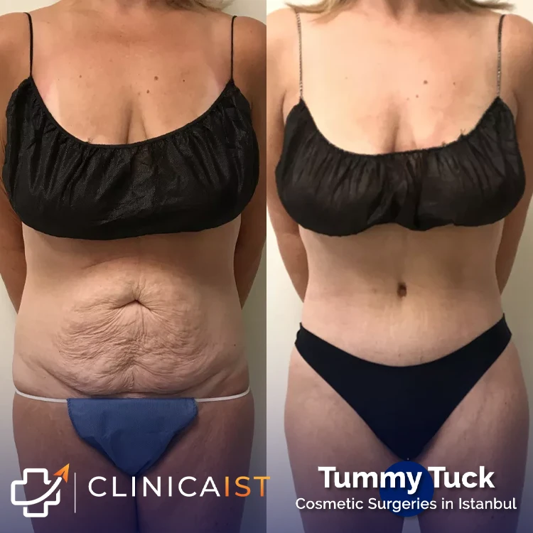 tummy-tuck-istanbul-before-after