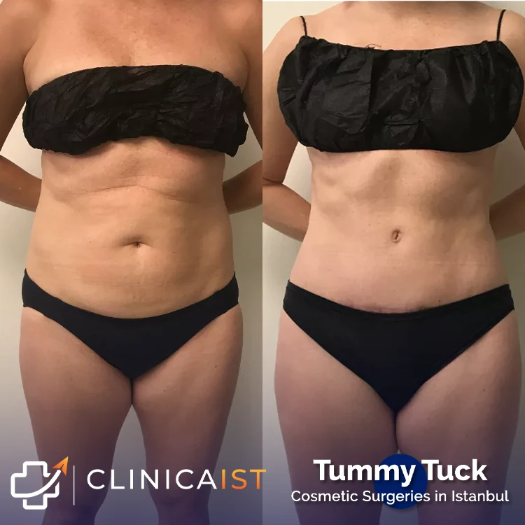 tummy-tuck-istanbul-before-and-after