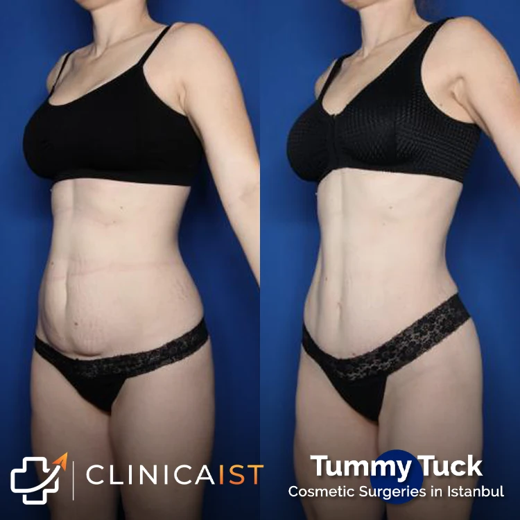 tummy-tuck-turkey-before-after
