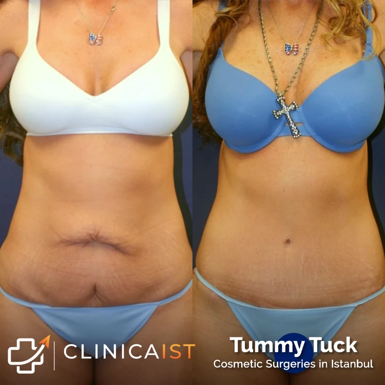 tummy-tuck-turkey-before-and-after-1
