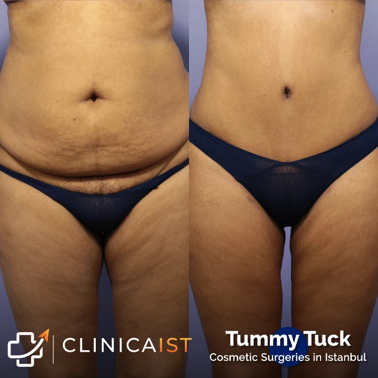 tummy-tuck-turkey-before-and-after