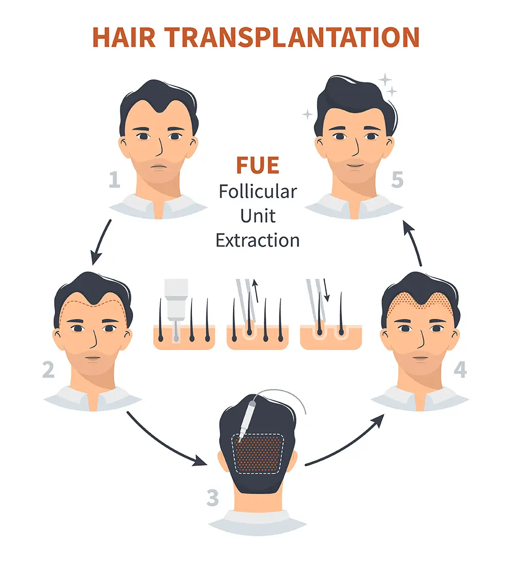 FUE hair transplant Istanbul