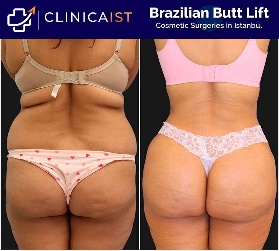bbl-before-after