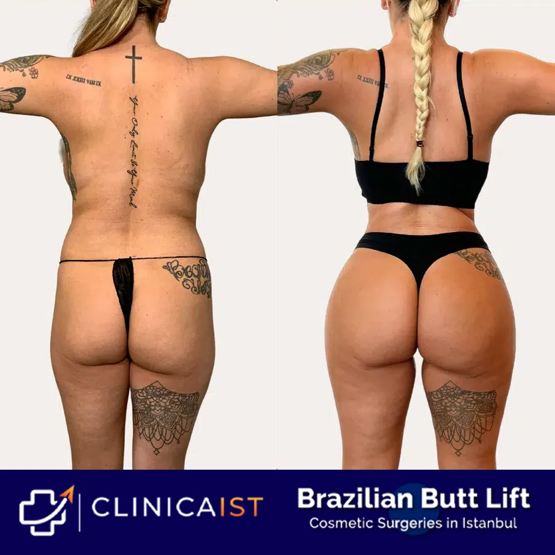 bbl-turkey-before-and-after