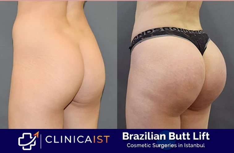brazilian-butt-lift-before-after