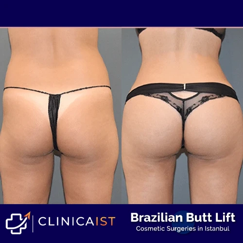brazilian-butt-lift-before-and-after