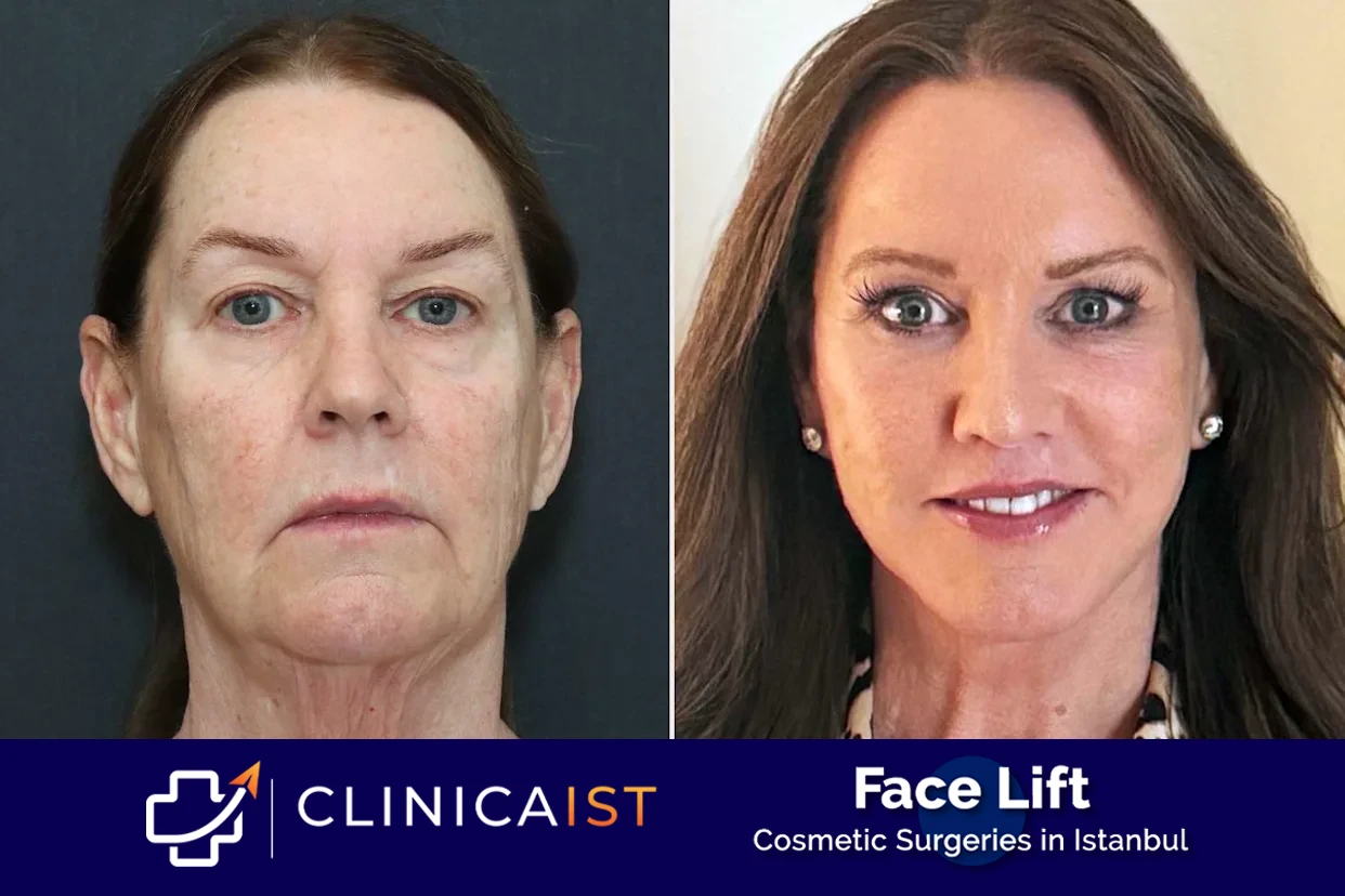 face-lift-turkey-before-after