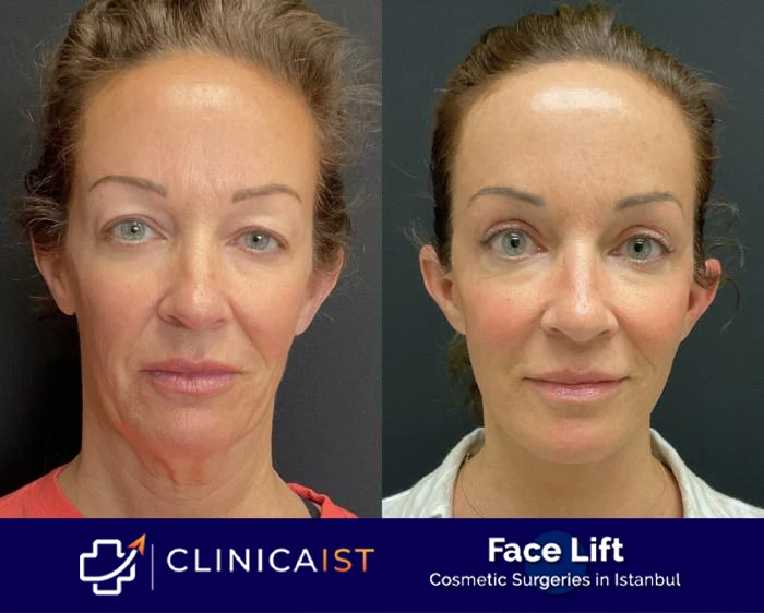 face-lift-turkey-before-and-after