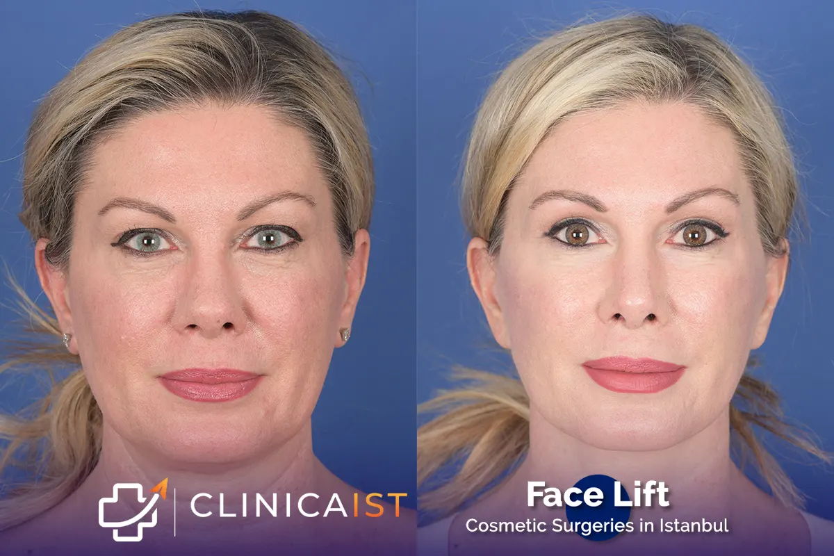 face-lift-turkey