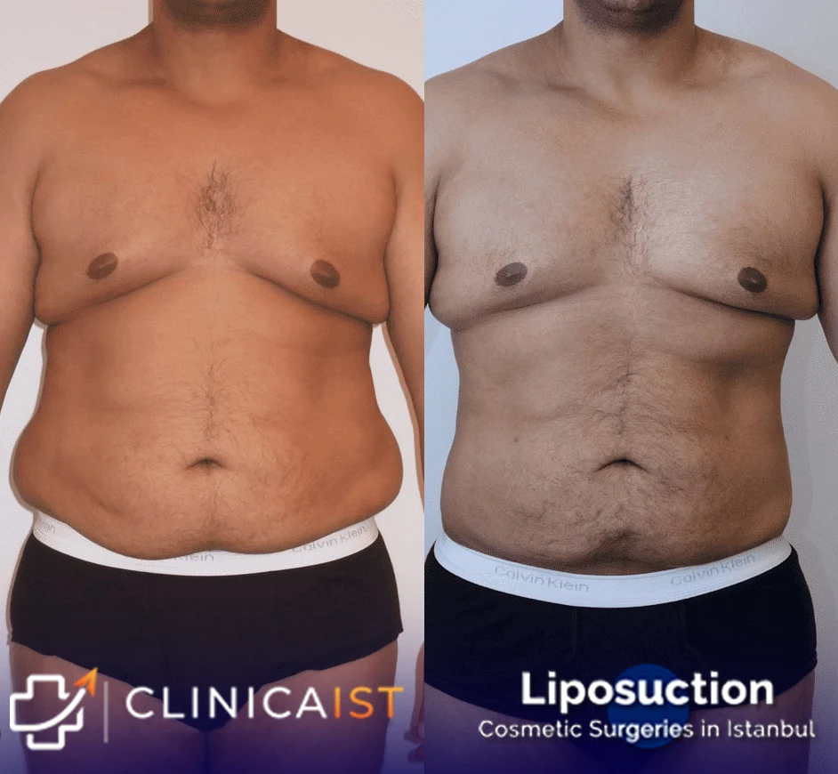 liposuction-istanbul-before-and-after