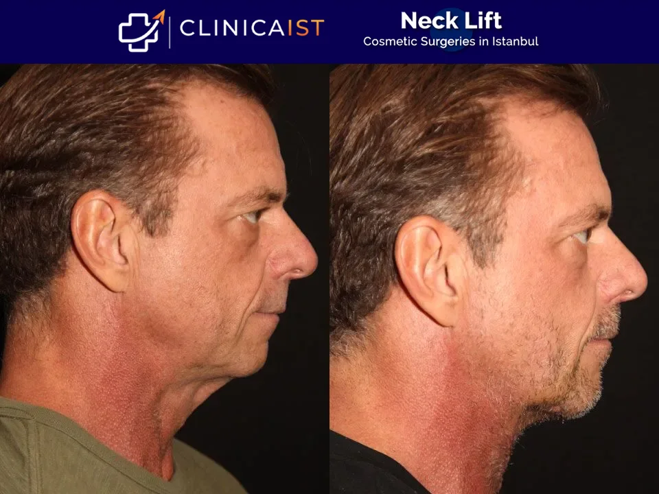 neck-lift-surgery-in-istanbul