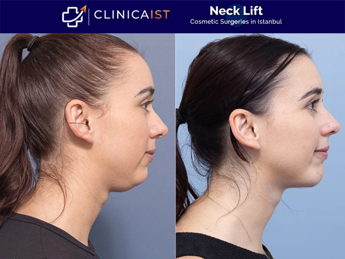 neck-lift-surgery-in-turkey