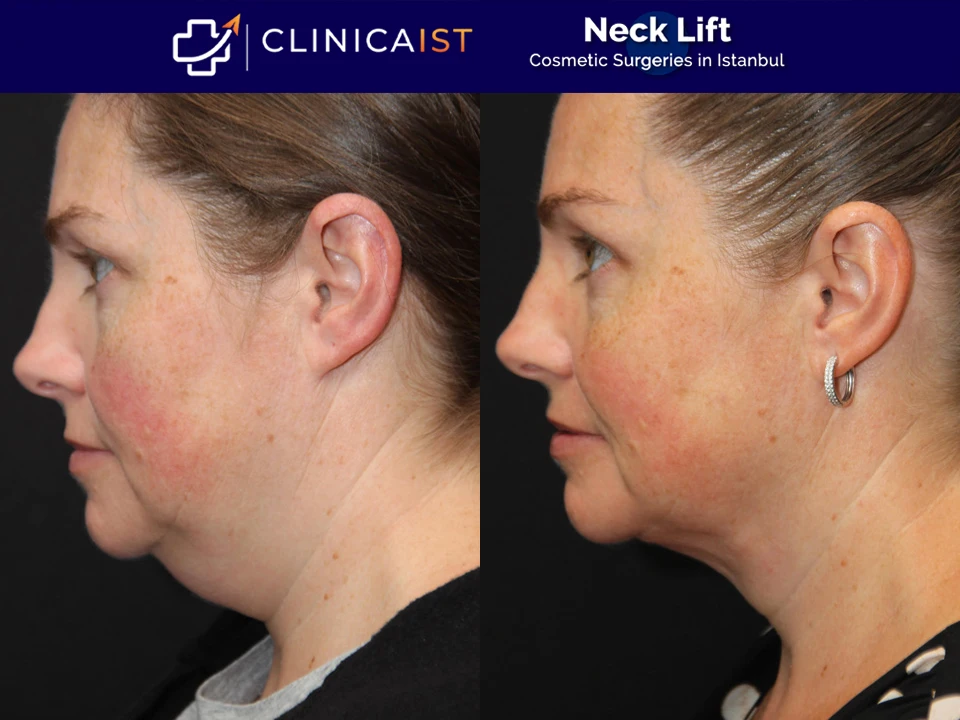 neck-lift-surgery-istanbul-before-after
