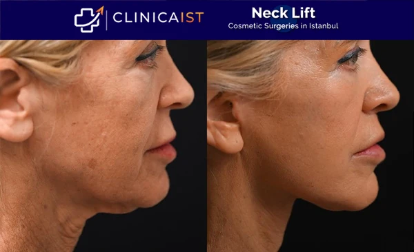 neck-lift-surgery-turkey-before-and-after