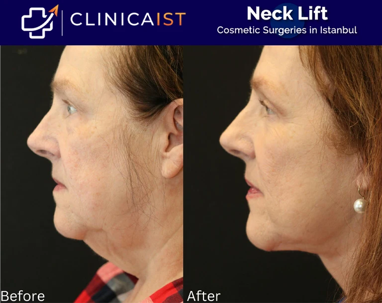 neck-lift-surgery-turkey