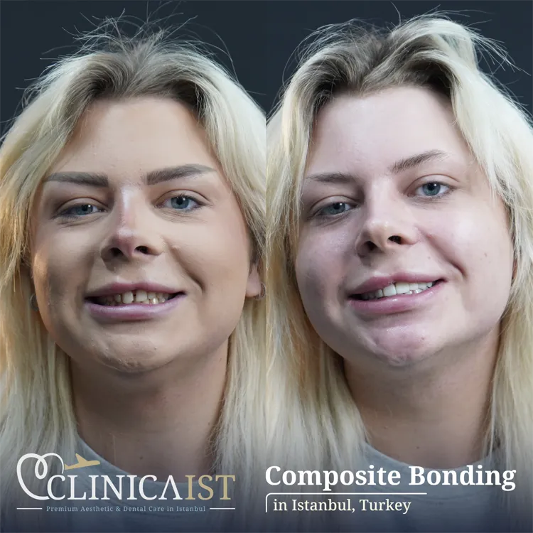 composite-bonding-in-istanbul