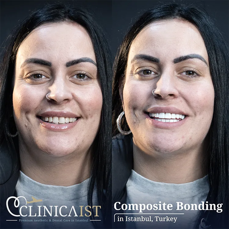 composite-bonding-in-turkey