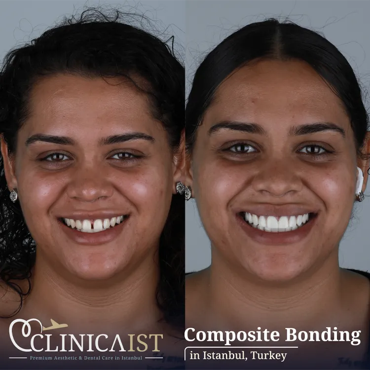 composite-bonding-istanbul