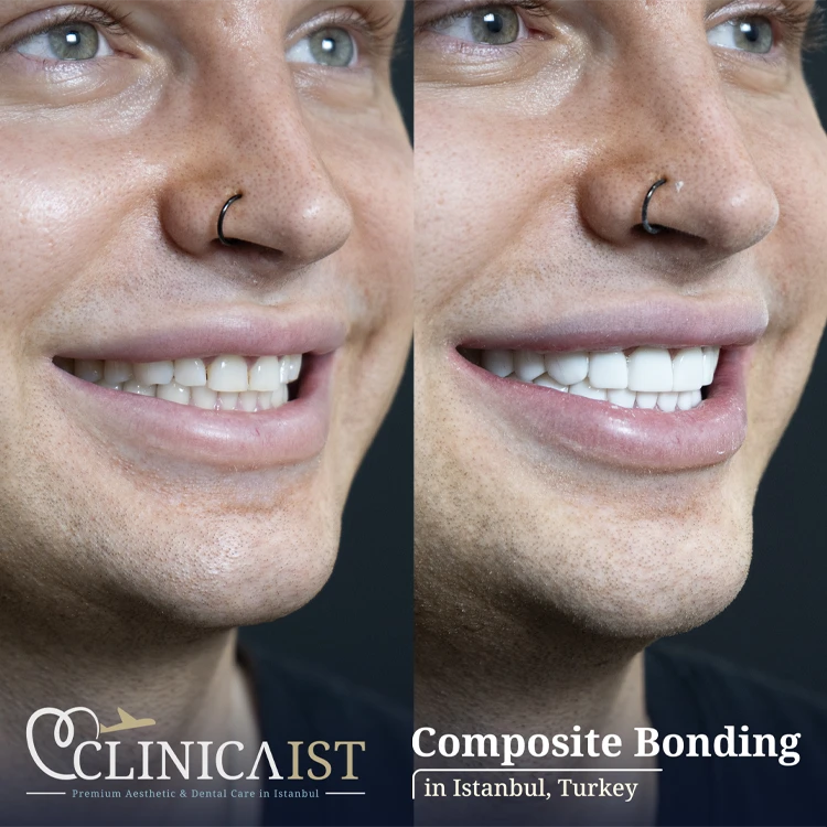 composite-bonding-turkey