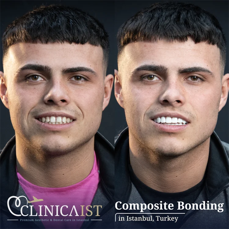 composite-bonding-turkey