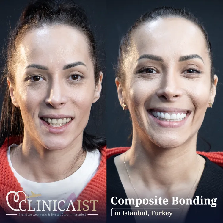 composite-bonding-turkey