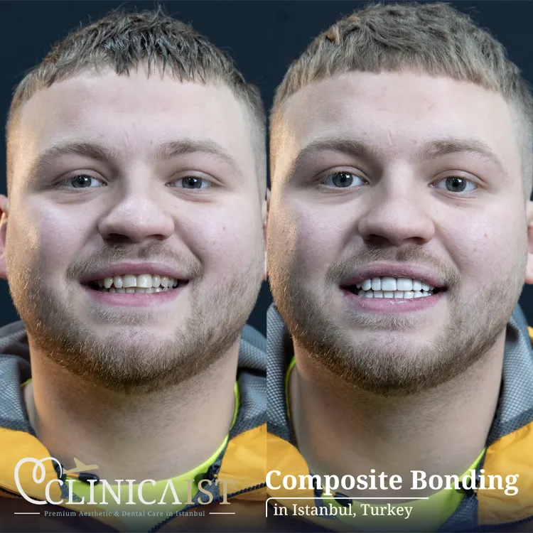 composite-bonding-turkey