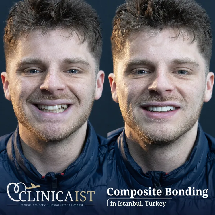 composite-bonding-turkey