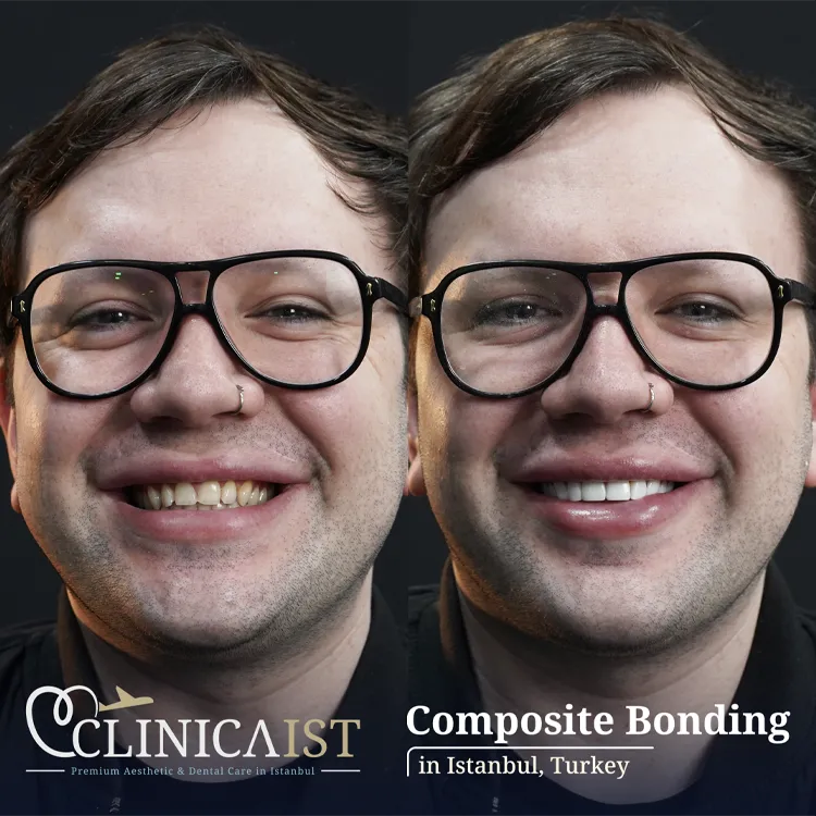 composite-bonding-turkey