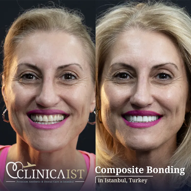 composite-bonding-turkey