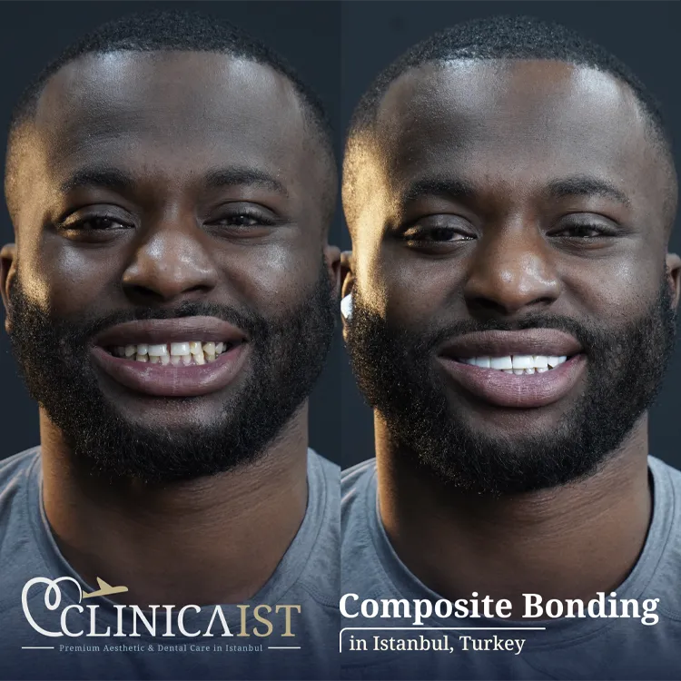 composite-bonding-turkey