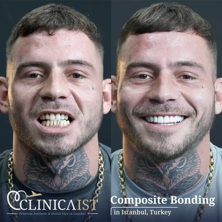 composite-bonding-turkey