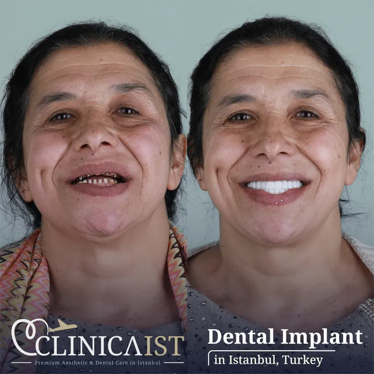 dental-implants-in-turkey
